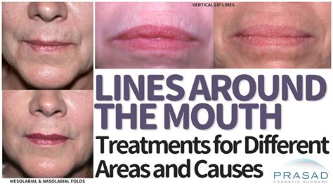 best face cream for lines around mouth